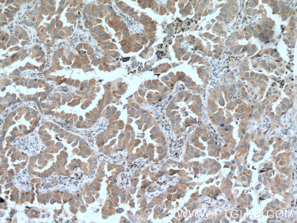 Immunohistochemistry (IHC) staining of human lung cancer tissue using PKC Alpha Monoclonal antibody (66421-1-Ig)
