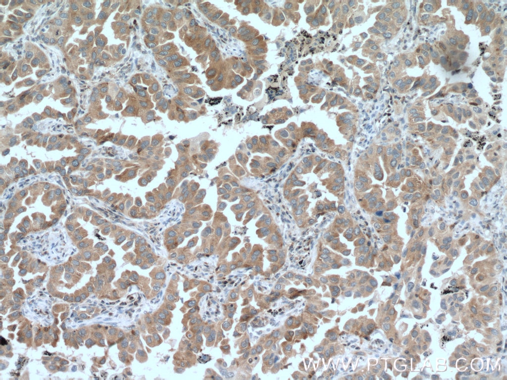 IHC staining of human lung cancer using 66421-1-Ig