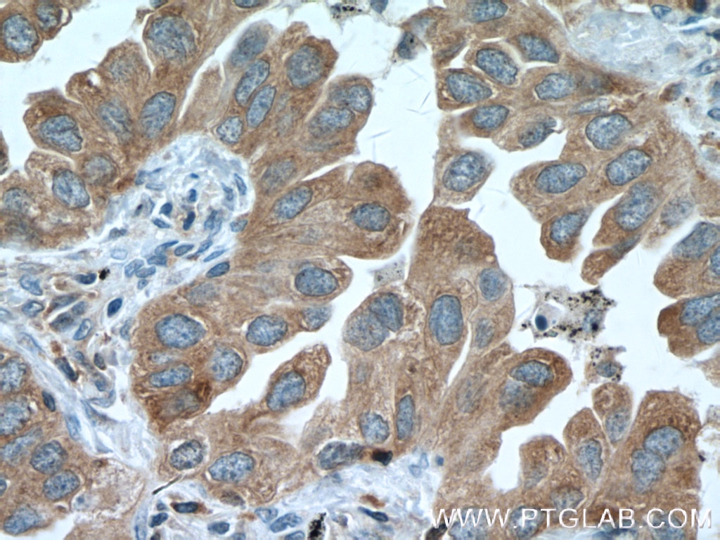 Immunohistochemistry (IHC) staining of human lung cancer tissue using PKC Alpha Monoclonal antibody (66421-1-Ig)