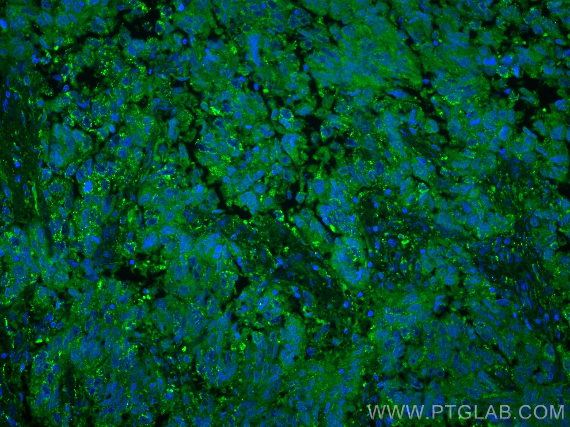 Immunofluorescence (IF) / fluorescent staining of human lung cancer tissue using PKC Iota Monoclonal antibody (66493-1-Ig)