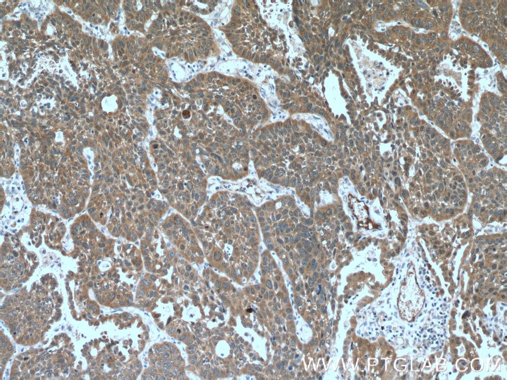 Immunohistochemistry (IHC) staining of human lung cancer tissue using PKC Iota Monoclonal antibody (66493-1-Ig)