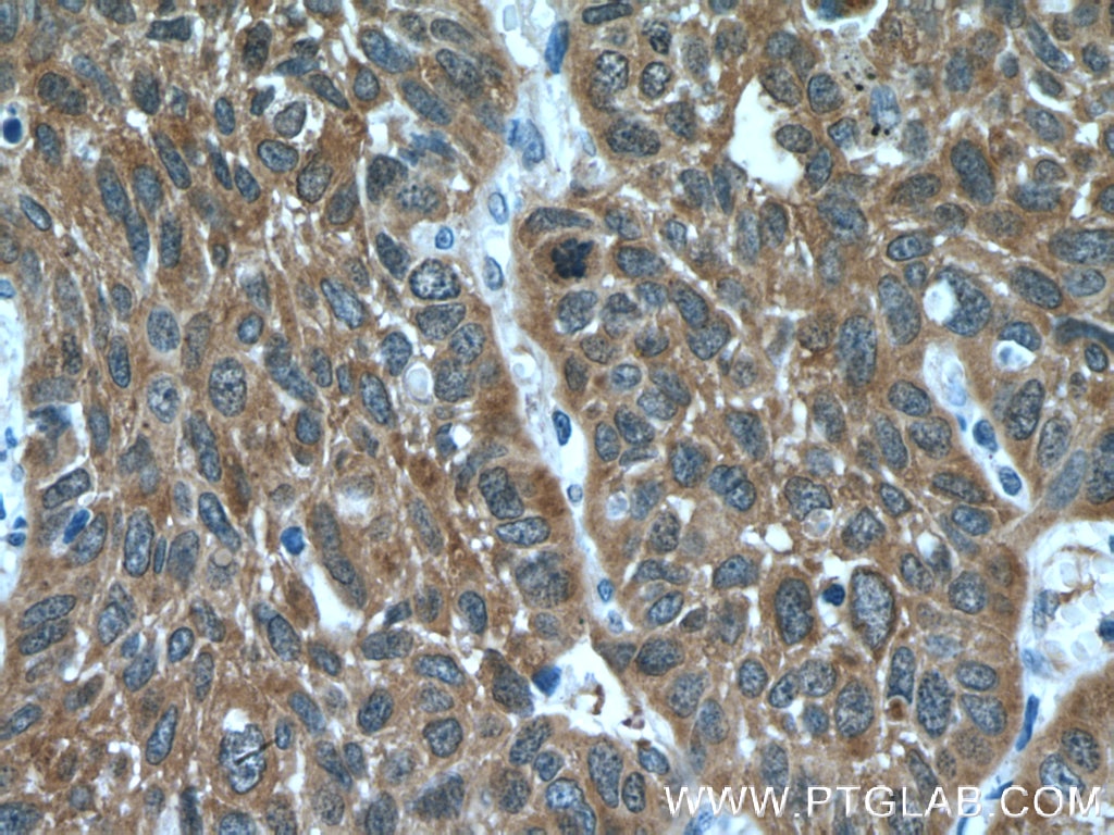 Immunohistochemistry (IHC) staining of human lung cancer tissue using PKC Iota Monoclonal antibody (66493-1-Ig)