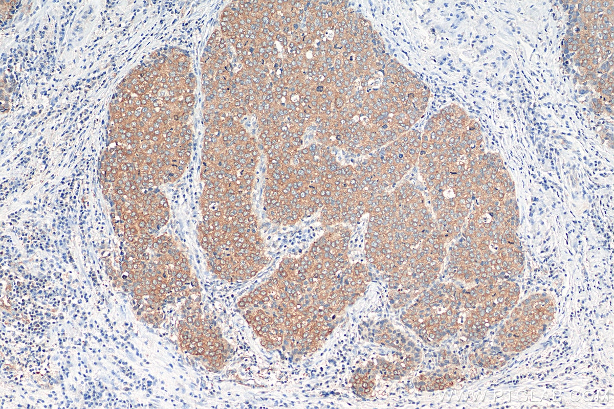 Immunohistochemistry (IHC) staining of human stomach cancer tissue using PKIB Polyclonal antibody (11942-1-AP)