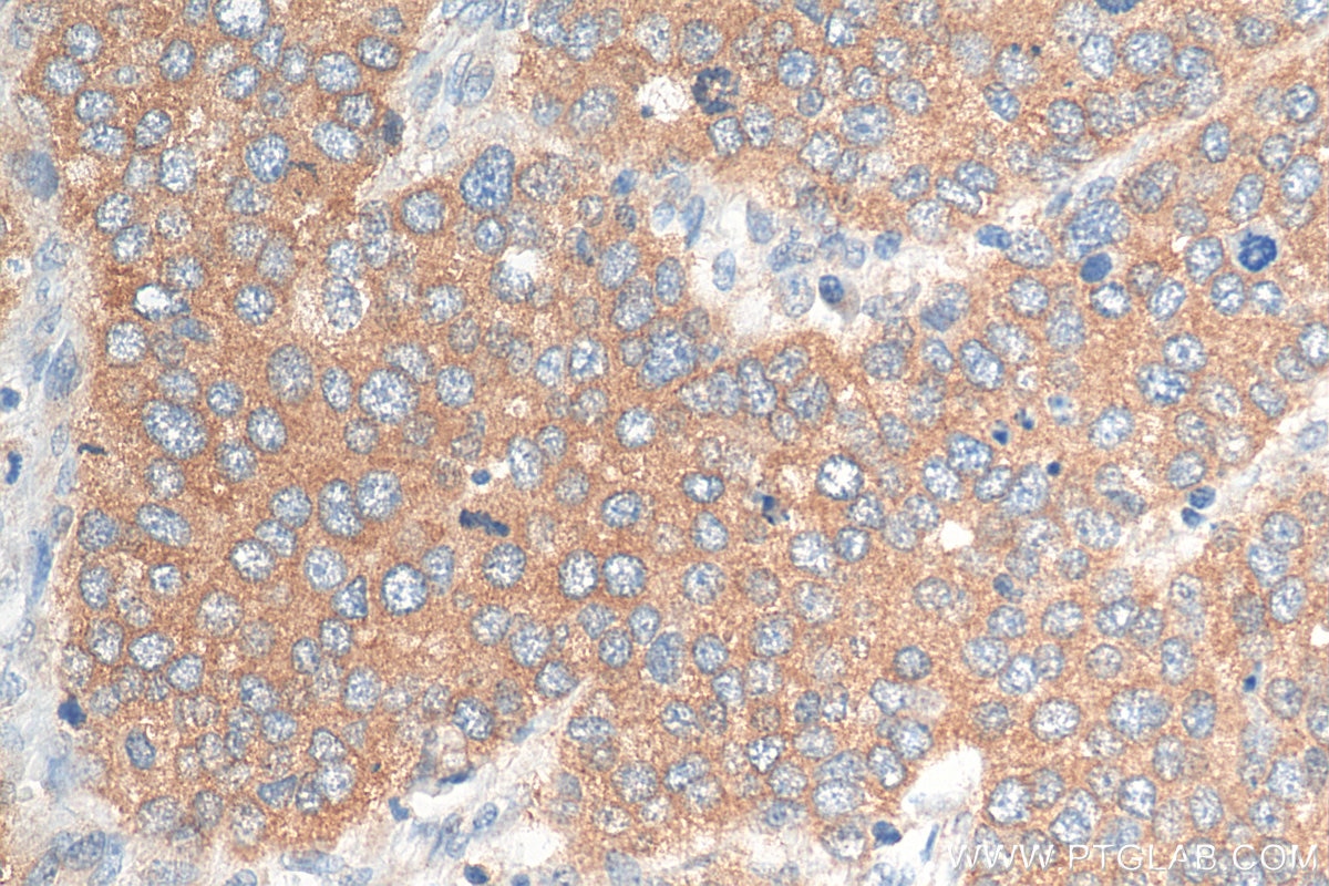 Immunohistochemistry (IHC) staining of human stomach cancer tissue using PKIB Polyclonal antibody (11942-1-AP)