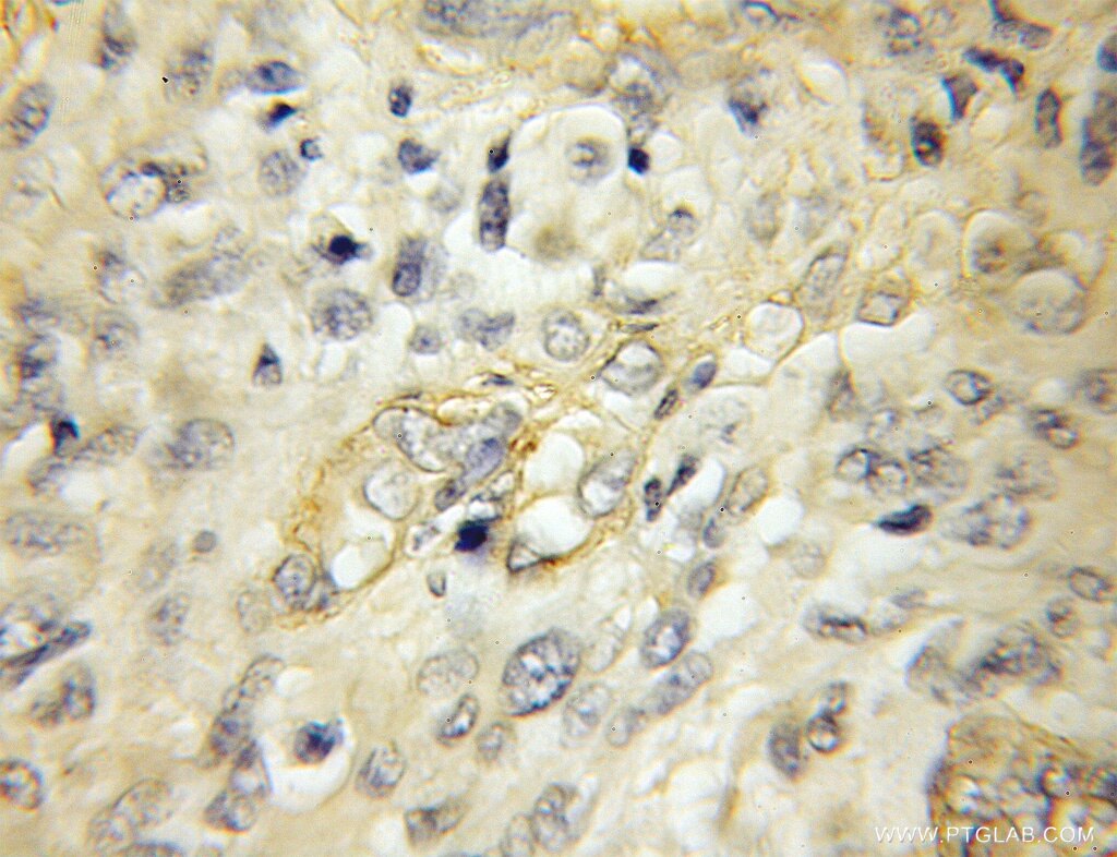 Immunohistochemistry (IHC) staining of human gliomas tissue using PKIB Polyclonal antibody (11942-1-AP)