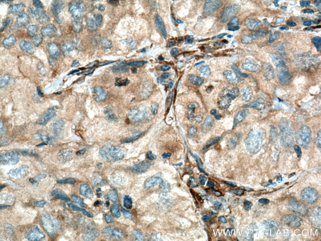 Immunohistochemistry (IHC) staining of human lung cancer tissue using PKLR Polyclonal antibody (22456-1-AP)