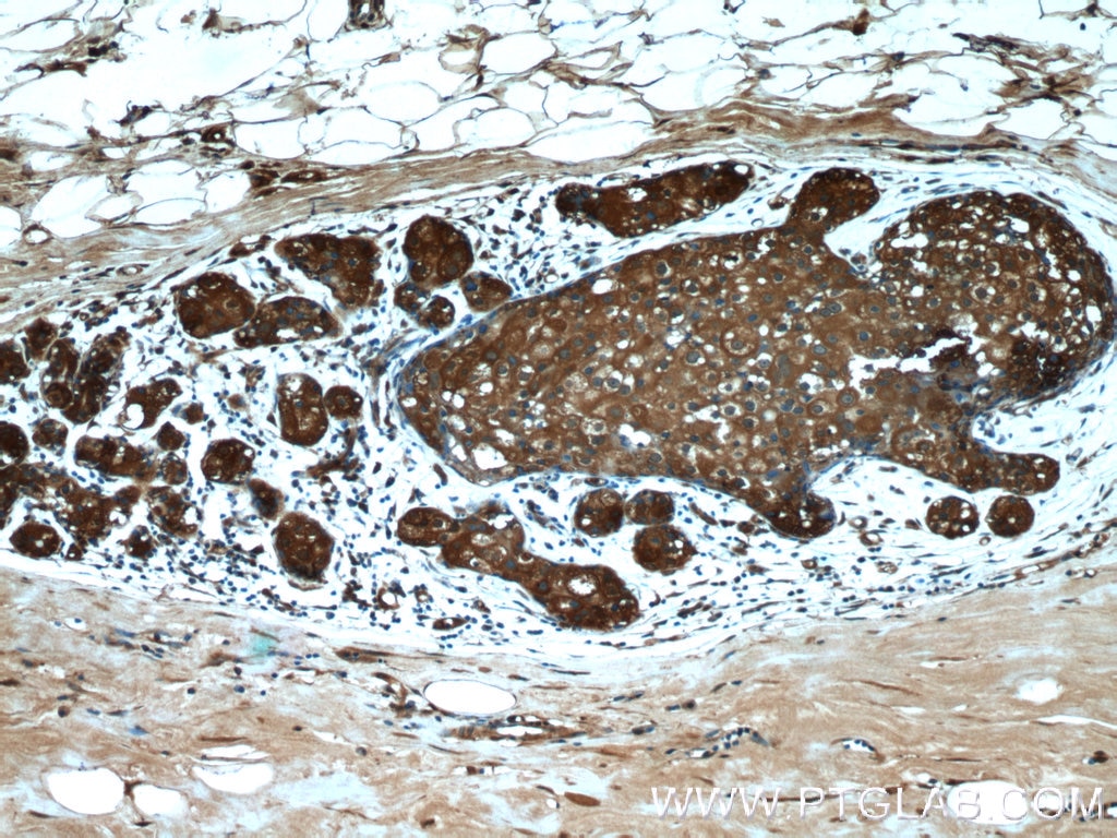 Immunohistochemistry (IHC) staining of human breast cancer tissue using PKLR Polyclonal antibody (22456-1-AP)