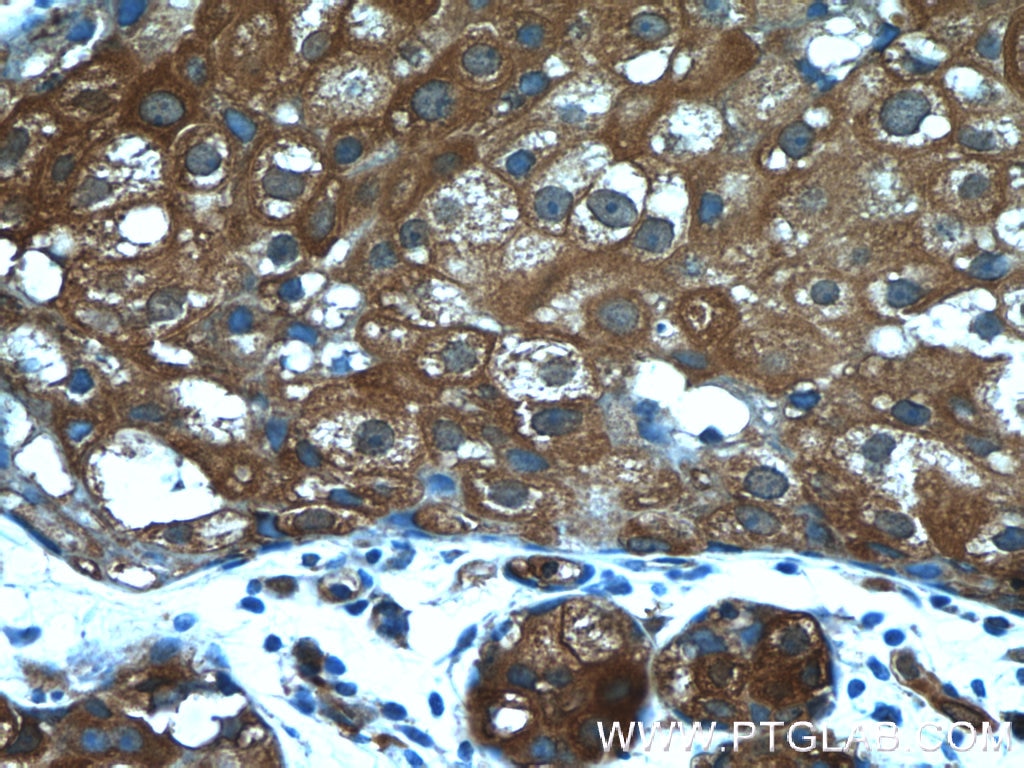 Immunohistochemistry (IHC) staining of human breast cancer tissue using PKLR Polyclonal antibody (22456-1-AP)