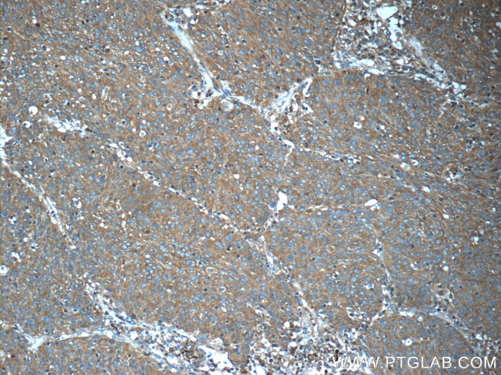 Immunohistochemistry (IHC) staining of human lung cancer tissue using PKLR Polyclonal antibody (22456-1-AP)