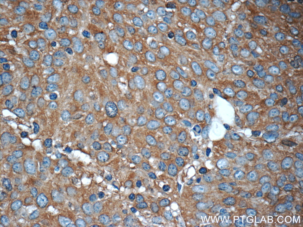 Immunohistochemistry (IHC) staining of human lung cancer tissue using PKLR Polyclonal antibody (22456-1-AP)