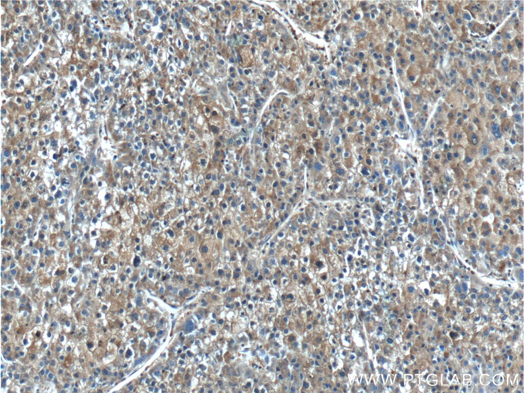 Immunohistochemistry (IHC) staining of human liver cancer tissue using PKM Polyclonal antibody (25659-1-AP)