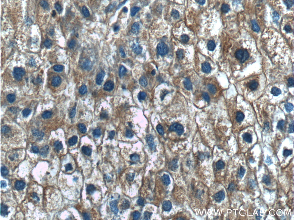 Immunohistochemistry (IHC) staining of human liver cancer tissue using PKM Polyclonal antibody (25659-1-AP)