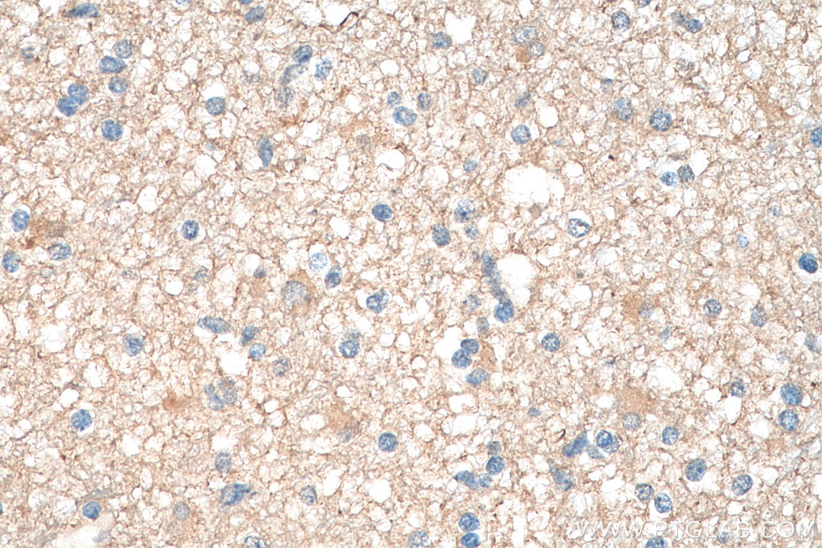 Immunohistochemistry (IHC) staining of human gliomas tissue using PKM1-specific Polyclonal antibody (15821-1-AP)