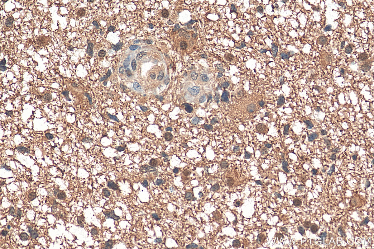 Immunohistochemistry (IHC) staining of human gliomas tissue using PKM1-specific Polyclonal antibody (15821-1-AP)