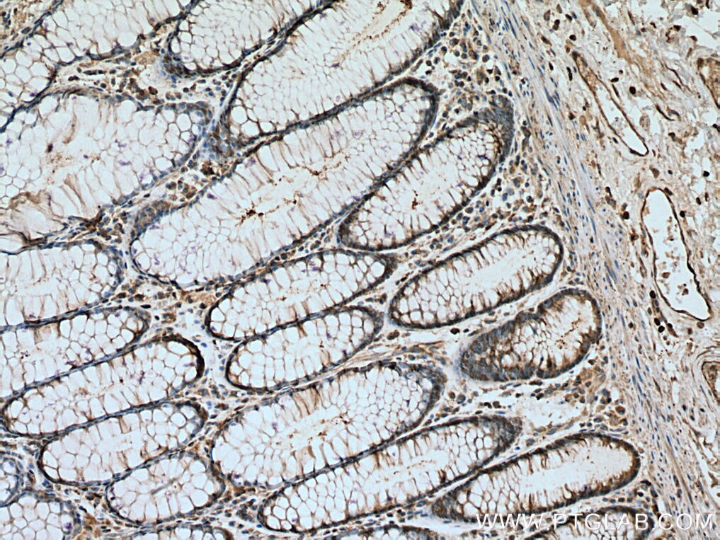 Immunohistochemistry (IHC) staining of human colon cancer tissue using PKM Polyclonal antibody (10078-2-AP)