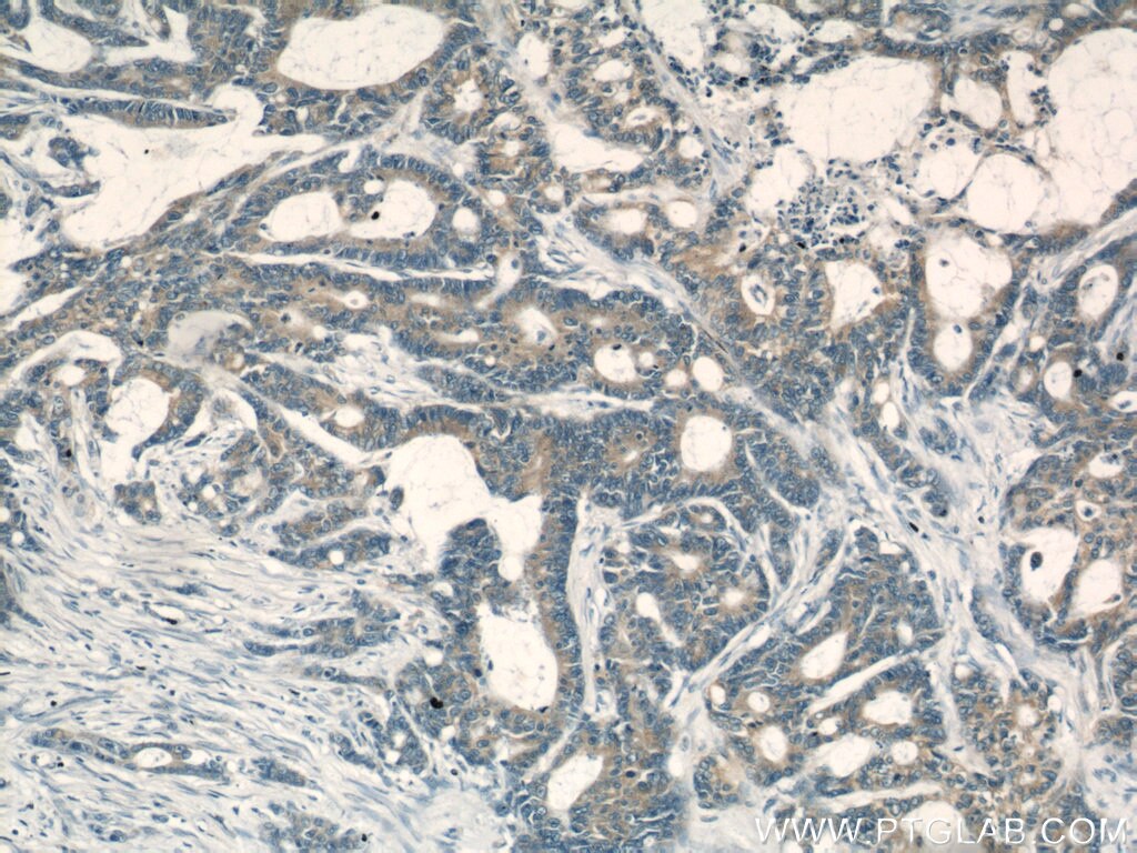 Immunohistochemistry (IHC) staining of human colon cancer tissue using PKM Polyclonal antibody (10078-2-AP)