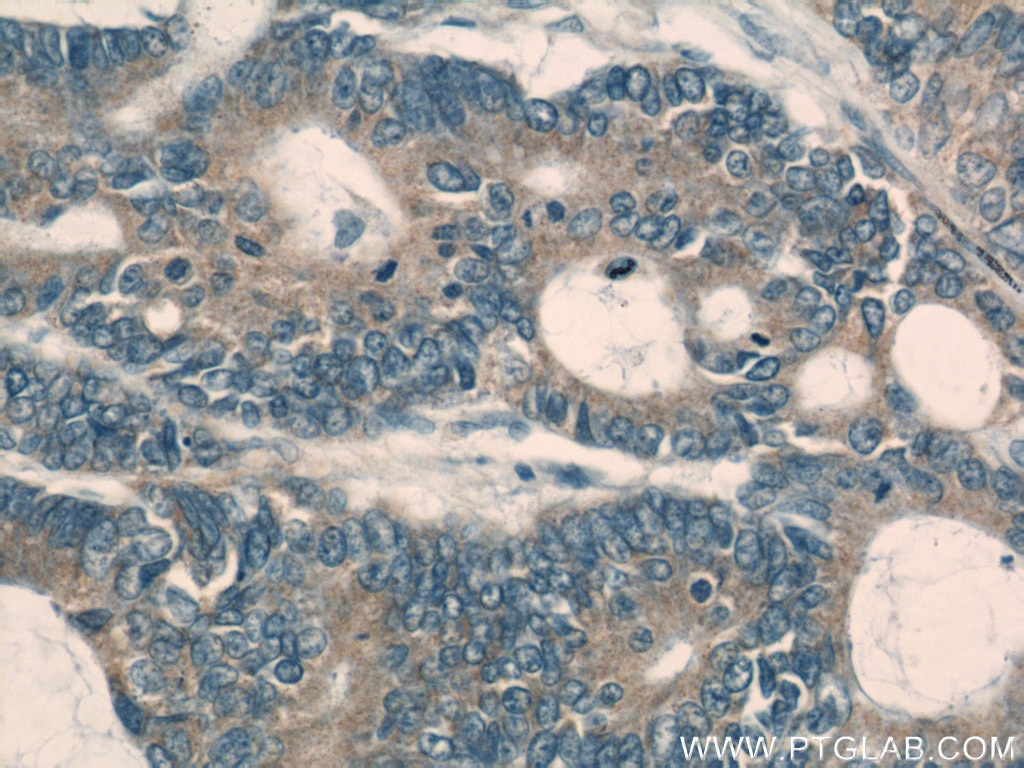 Immunohistochemistry (IHC) staining of human colon cancer tissue using PKM Polyclonal antibody (10078-2-AP)