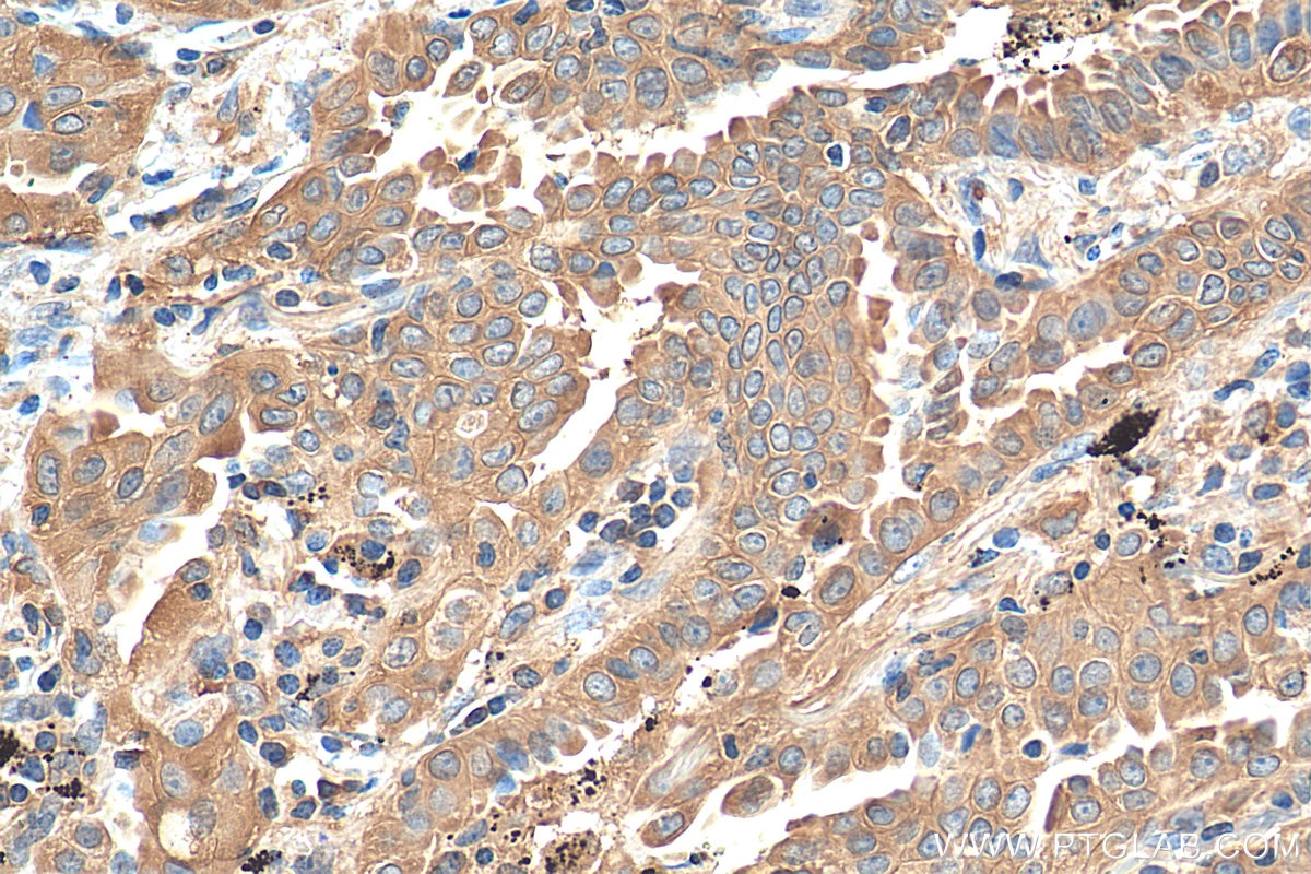 Immunohistochemistry (IHC) staining of human lung cancer tissue using PKM2-specific Polyclonal antibody (15822-1-AP)