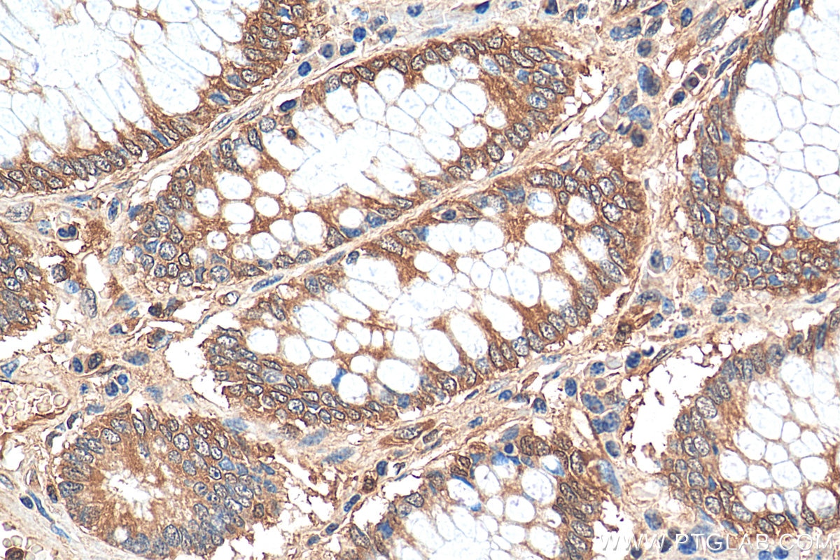 Immunohistochemistry (IHC) staining of human colon cancer tissue using PKM2-specific Polyclonal antibody (15822-1-AP)