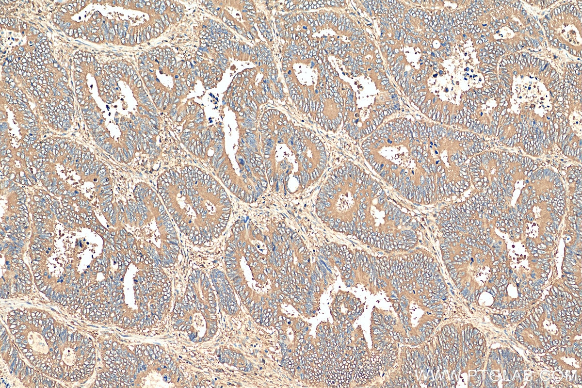 Immunohistochemistry (IHC) staining of human colon cancer tissue using PKM2-specific Polyclonal antibody (15822-1-AP)