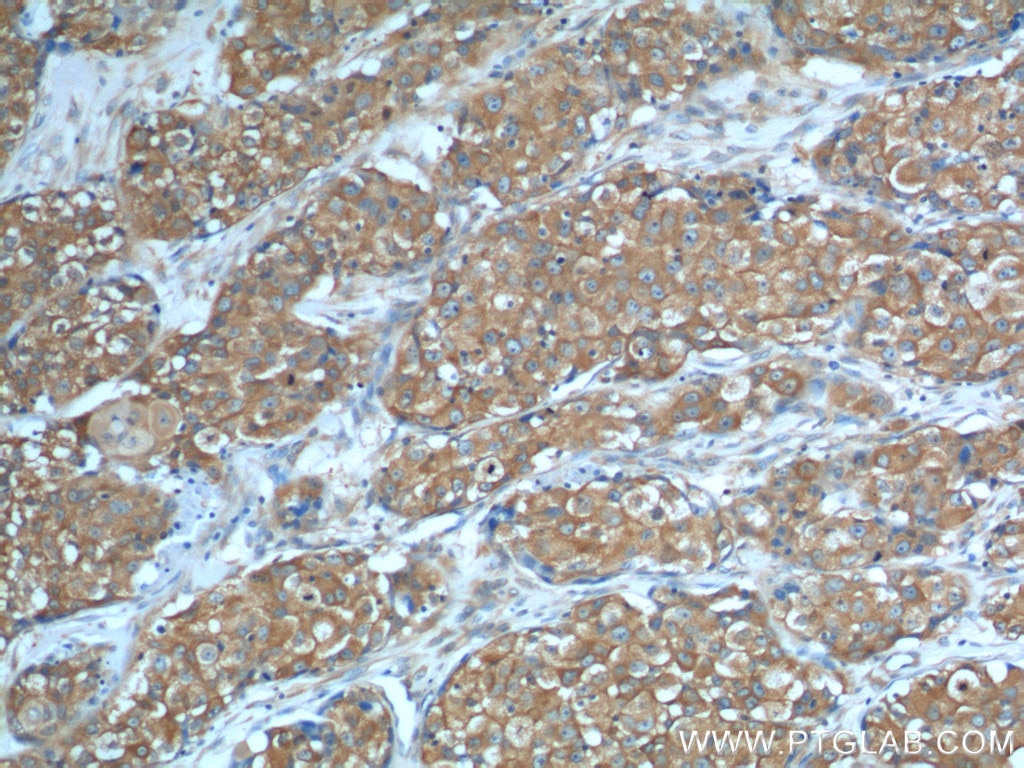 Immunohistochemistry (IHC) staining of human lung cancer tissue using PKM2-specific Polyclonal antibody (15822-1-AP)