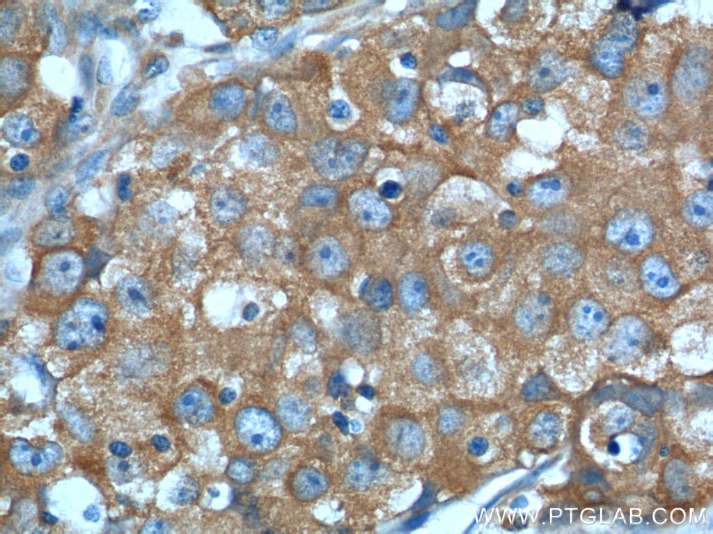 Immunohistochemistry (IHC) staining of human lung cancer tissue using PKM2-specific Polyclonal antibody (15822-1-AP)