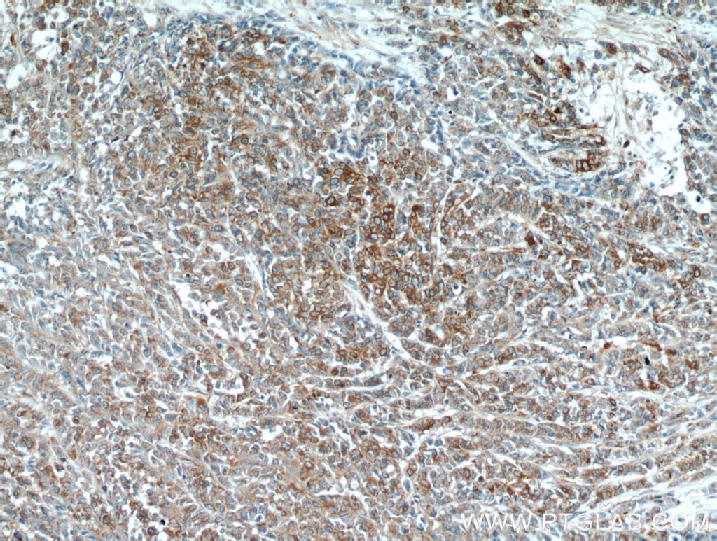 Immunohistochemistry (IHC) staining of human colon cancer tissue using PKM2-specific Polyclonal antibody (15822-1-AP)