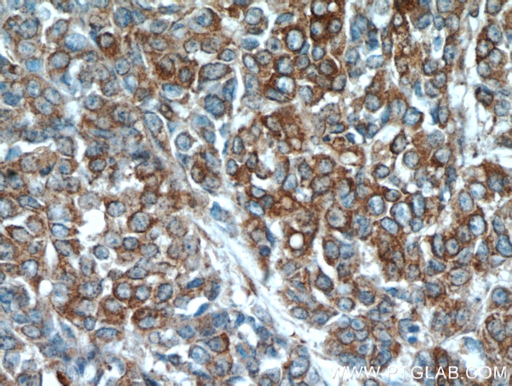 Immunohistochemistry (IHC) staining of human colon cancer tissue using PKM2-specific Polyclonal antibody (15822-1-AP)