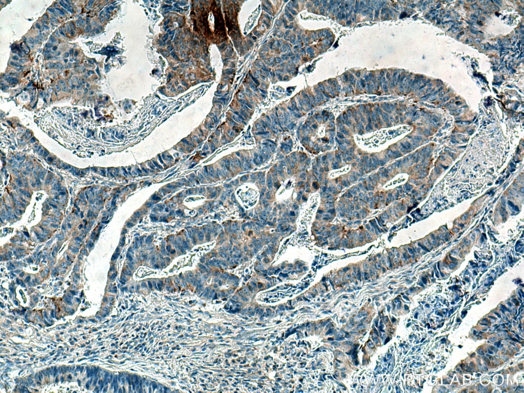 Immunohistochemistry (IHC) staining of human colon cancer tissue using PKMYT1 Monoclonal antibody (67806-1-Ig)