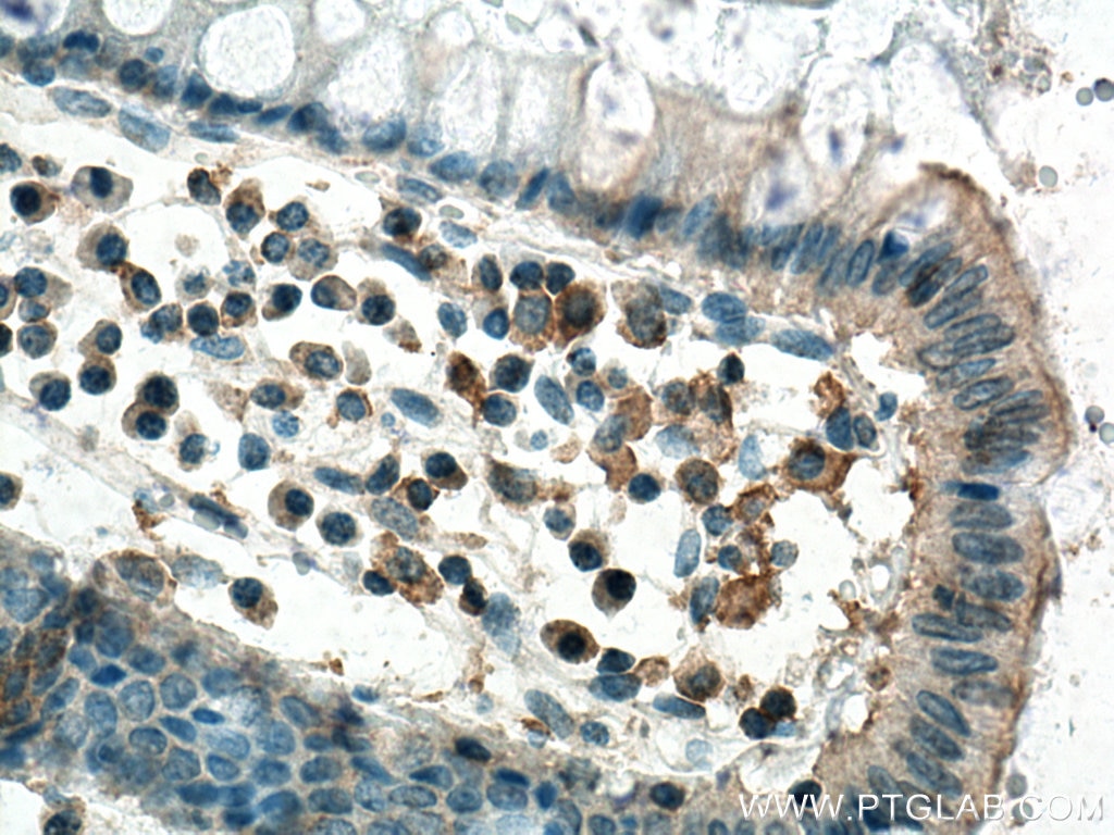 Immunohistochemistry (IHC) staining of human colon cancer tissue using PKMYT1 Monoclonal antibody (67806-1-Ig)