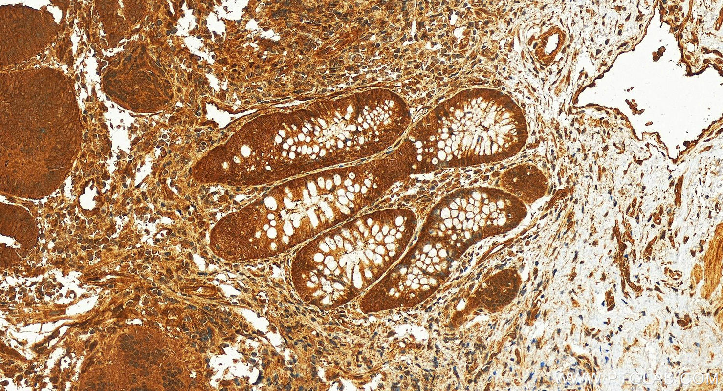 Immunohistochemistry (IHC) staining of human colon cancer tissue using PKN2 Polyclonal antibody (14608-1-AP)