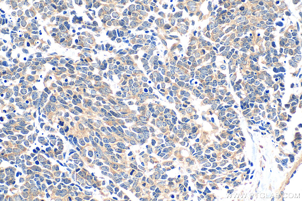 Immunohistochemical analysis of paraffin-embedded human lung cancer tissue slide using 14608-1-AP (PKN2 antibody) at dilution of 1:500 (under 40x lens). Heat mediated antigen retrieval with Tris-EDTA buffer (pH 9.0). Immunohistochemistry (IHC) staining of human lung cancer tissue using PKN2 Polyclonal antibody (14608-1-AP)