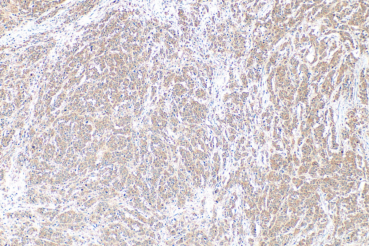 Immunohistochemical analysis of paraffin-embedded human colon cancer tissue slide using 14608-1-AP (PKN2 antibody) at dilution of 1:500 (under 10x lens). Heat mediated antigen retrieval with Tris-EDTA buffer (pH 9.0). Immunohistochemistry (IHC) staining of human colon cancer tissue using PKN2 Polyclonal antibody (14608-1-AP)