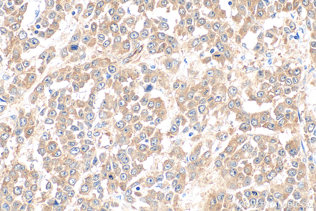 Immunohistochemical analysis of paraffin-embedded human colon cancer tissue slide using 14608-1-AP (PKN2 antibody) at dilution of 1:500 (under 40x lens). Heat mediated antigen retrieval with Tris-EDTA buffer (pH 9.0). Immunohistochemistry (IHC) staining of human colon cancer tissue using PKN2 Polyclonal antibody (14608-1-AP)