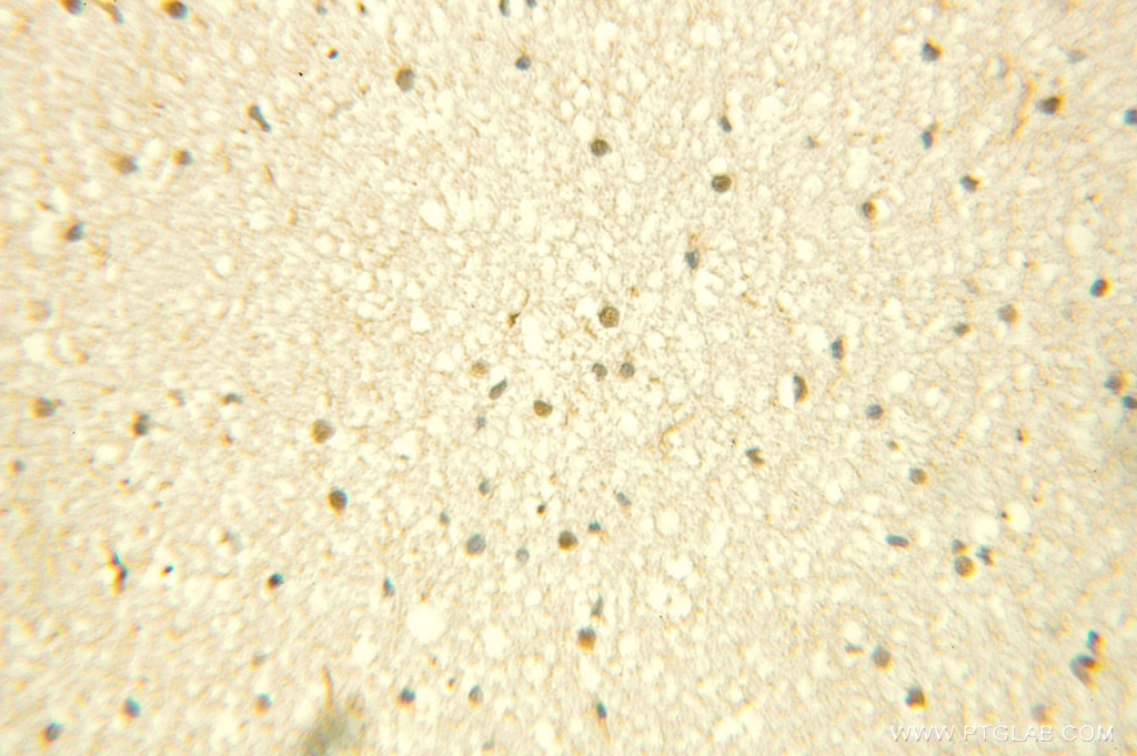 IHC staining of human gliomas using 10614-1-AP