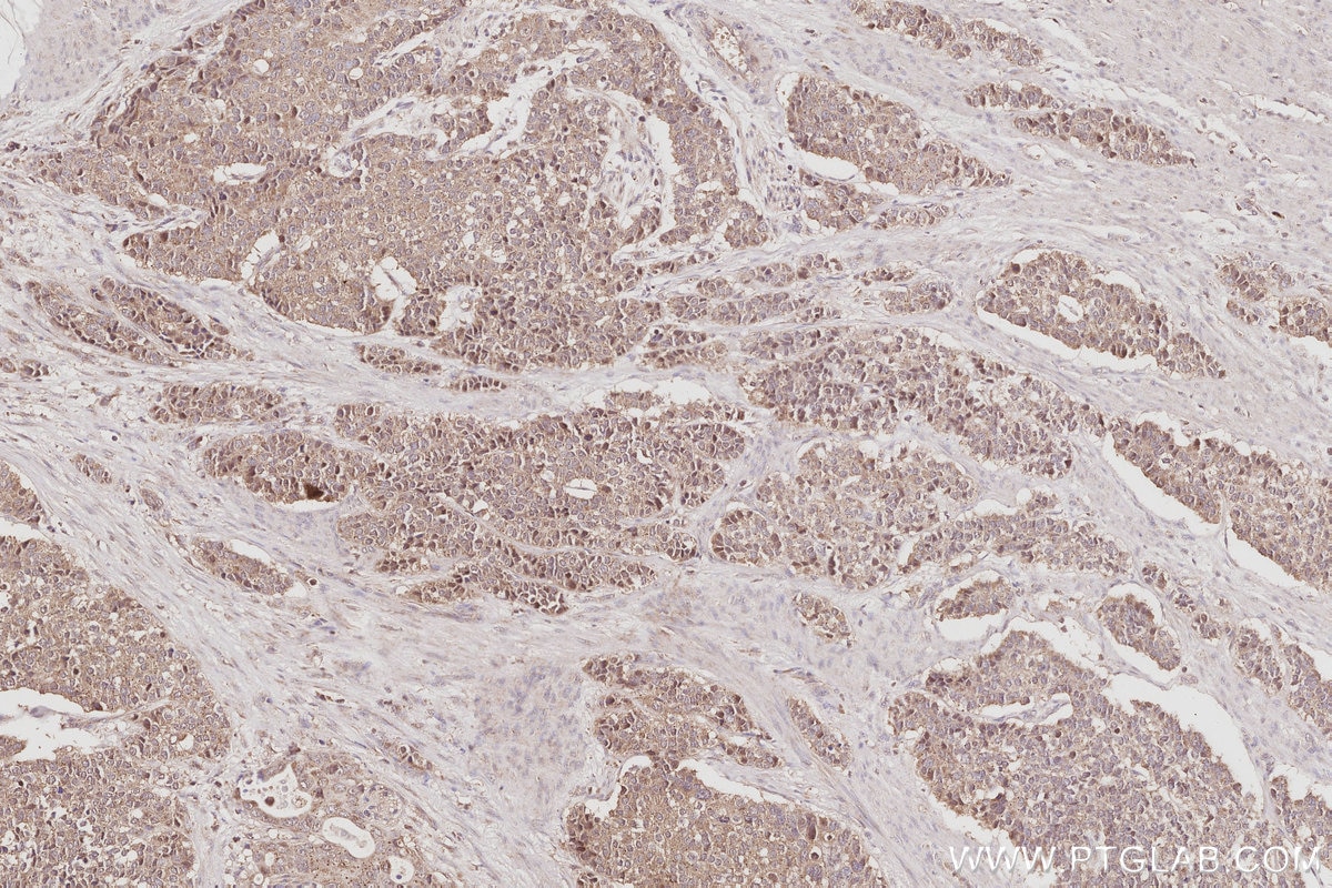 Immunohistochemistry (IHC) staining of human stomach cancer tissue using Plakophilin 3 Polyclonal antibody (18338-1-AP)