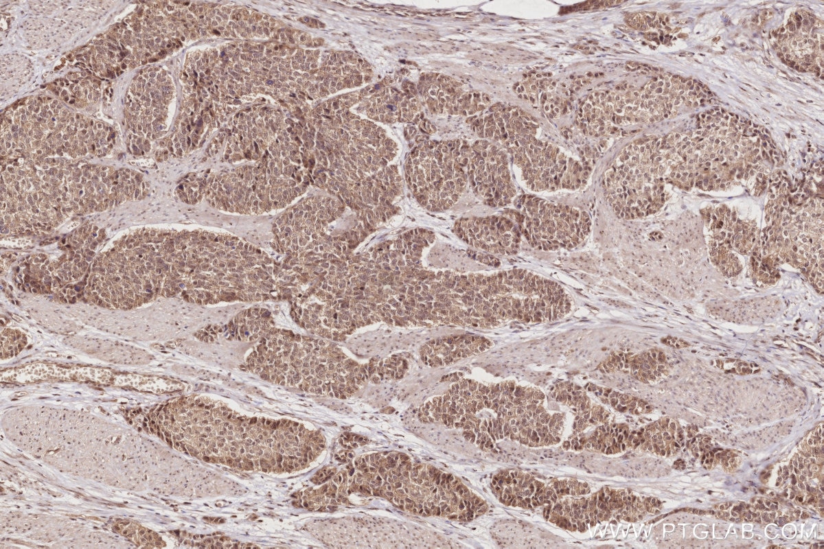 Immunohistochemistry (IHC) staining of human stomach cancer tissue using PKP4 Polyclonal antibody (14062-1-AP)