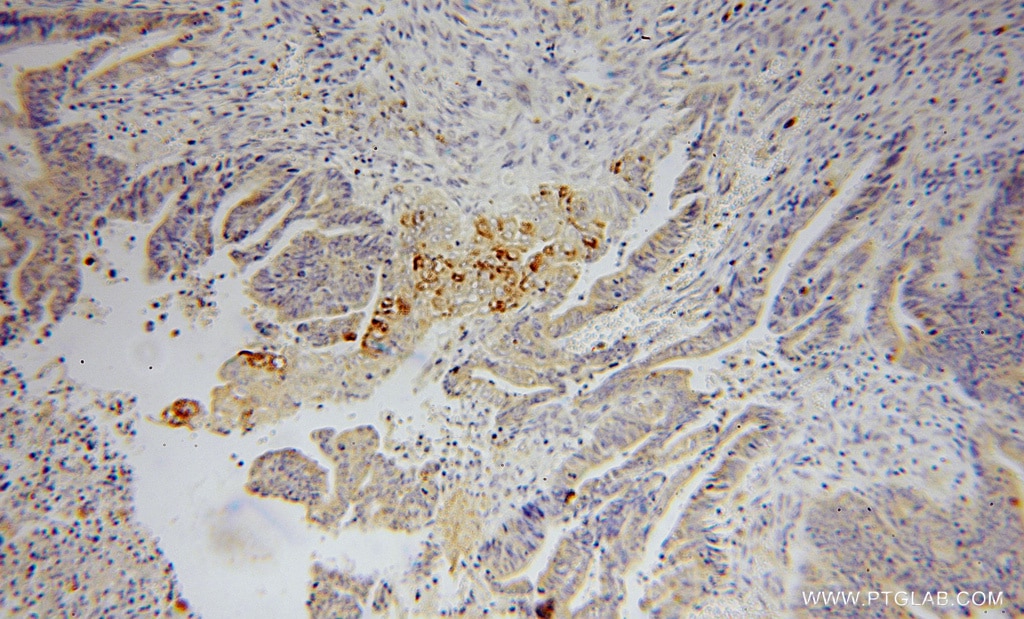 Immunohistochemistry (IHC) staining of human colon cancer tissue using PLA2G12A Polyclonal antibody (16009-1-AP)