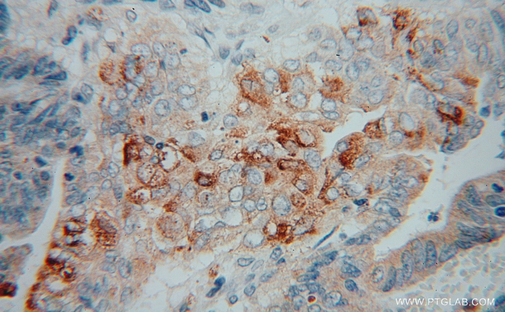 Immunohistochemistry (IHC) staining of human colon cancer tissue using PLA2G12A Polyclonal antibody (16009-1-AP)