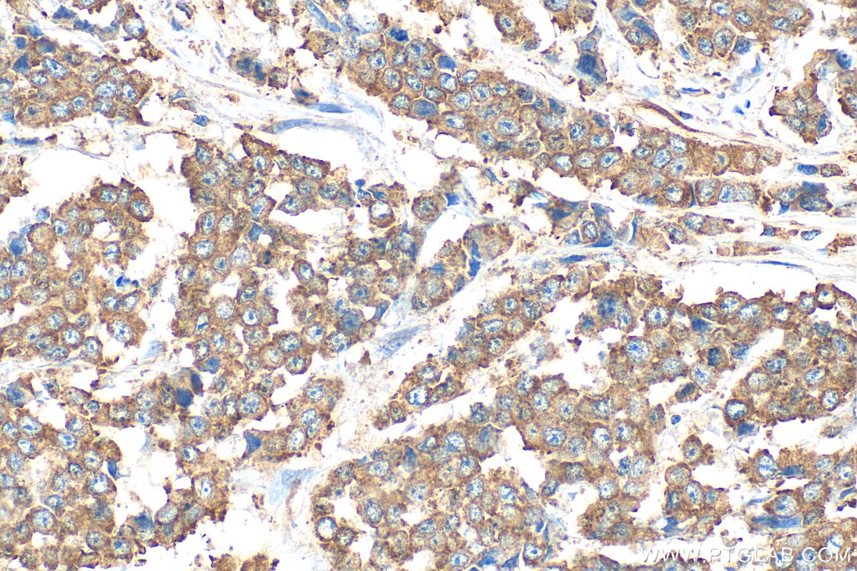 Immunohistochemistry (IHC) staining of human colon cancer tissue using PLA2G12B Polyclonal antibody (25799-1-AP)