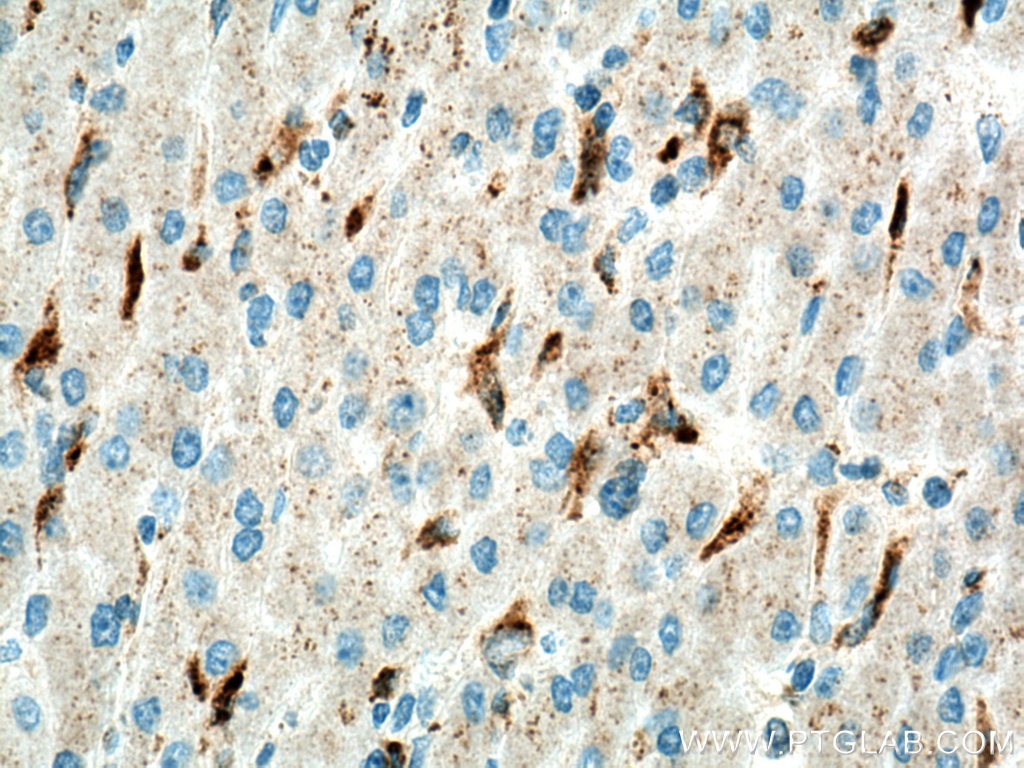 Immunohistochemistry (IHC) staining of human liver cancer tissue using LYPLA3 Polyclonal antibody (10863-2-AP)