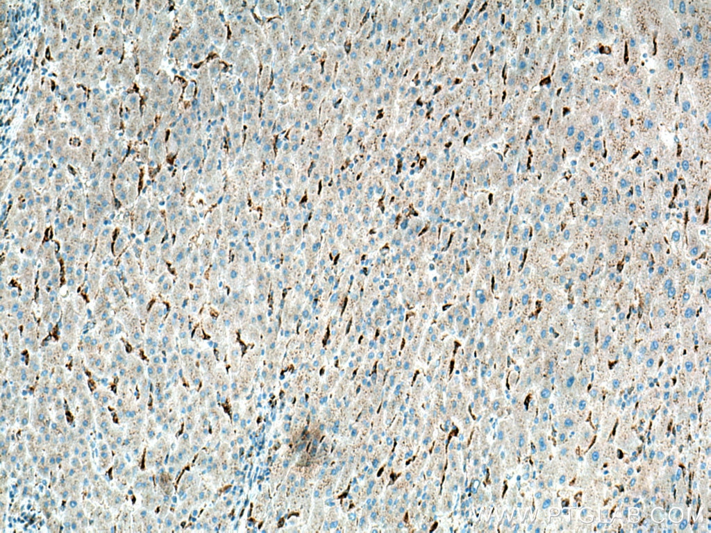IHC staining of human liver cancer using 10863-2-AP