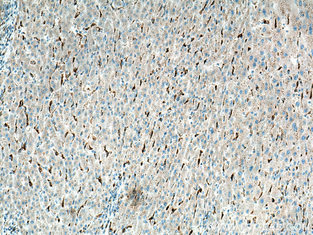 Immunohistochemistry (IHC) staining of human liver cancer tissue using LYPLA3 Polyclonal antibody (10863-2-AP)