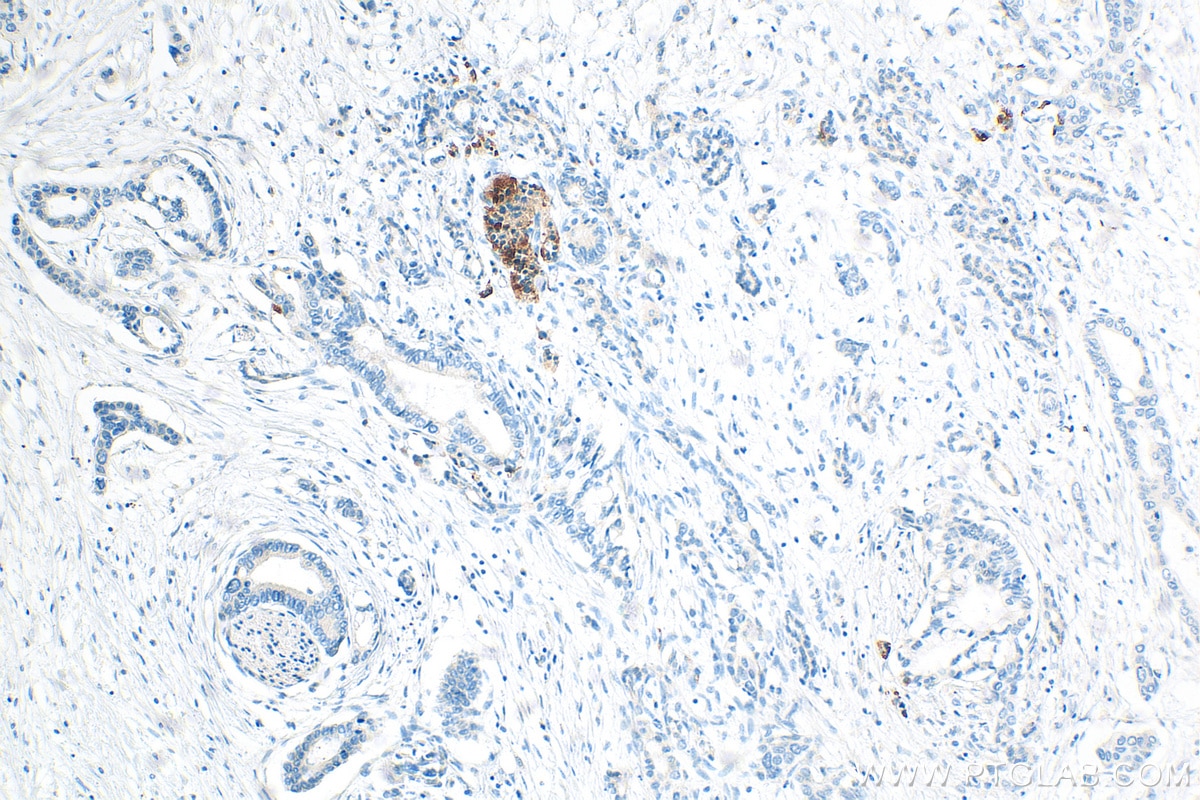 Immunohistochemistry (IHC) staining of human pancreas cancer tissue using PLA2G1B Polyclonal antibody (15843-1-AP)
