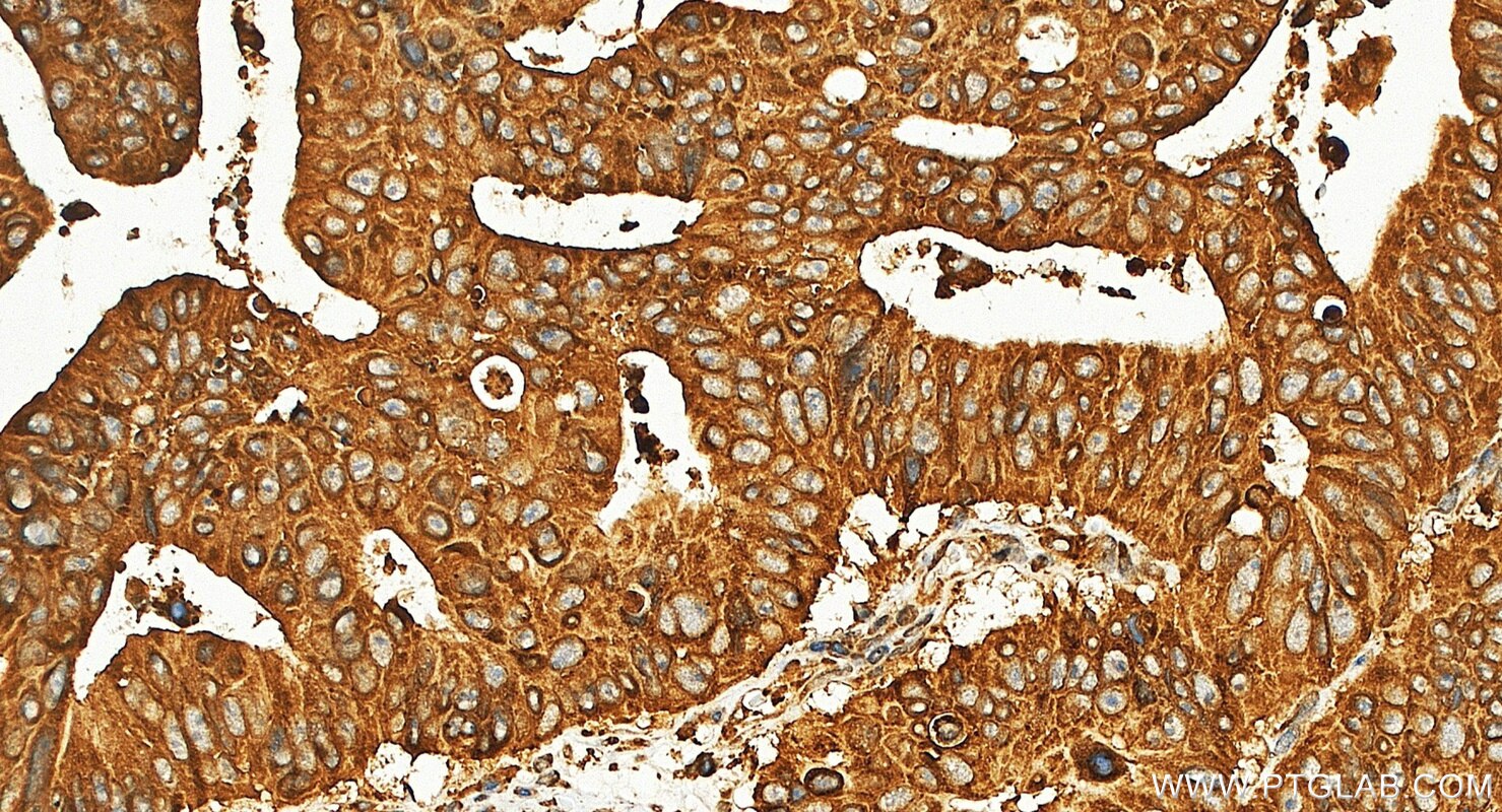 Immunohistochemistry (IHC) staining of human colon cancer tissue using PLA2G3 Polyclonal antibody (17646-1-AP)