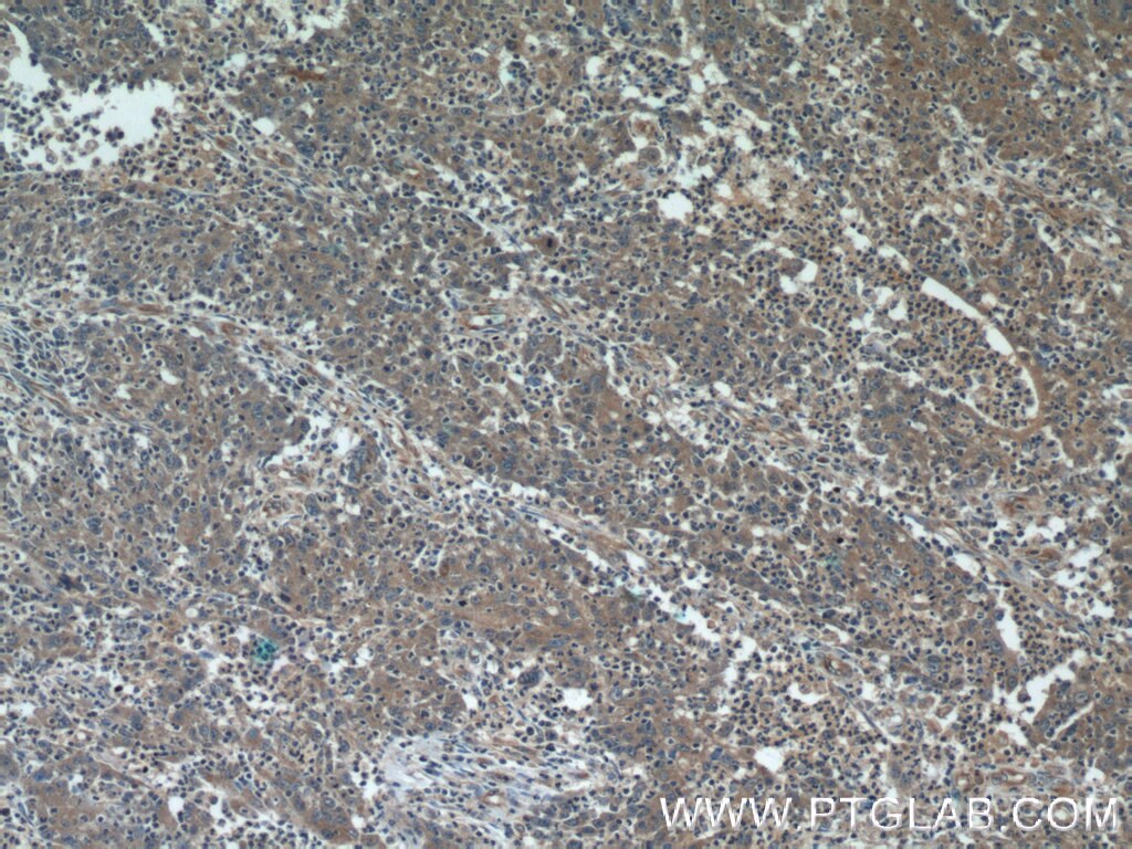 Immunohistochemistry (IHC) staining of human colon cancer tissue using PLA2G3 Polyclonal antibody (17646-1-AP)