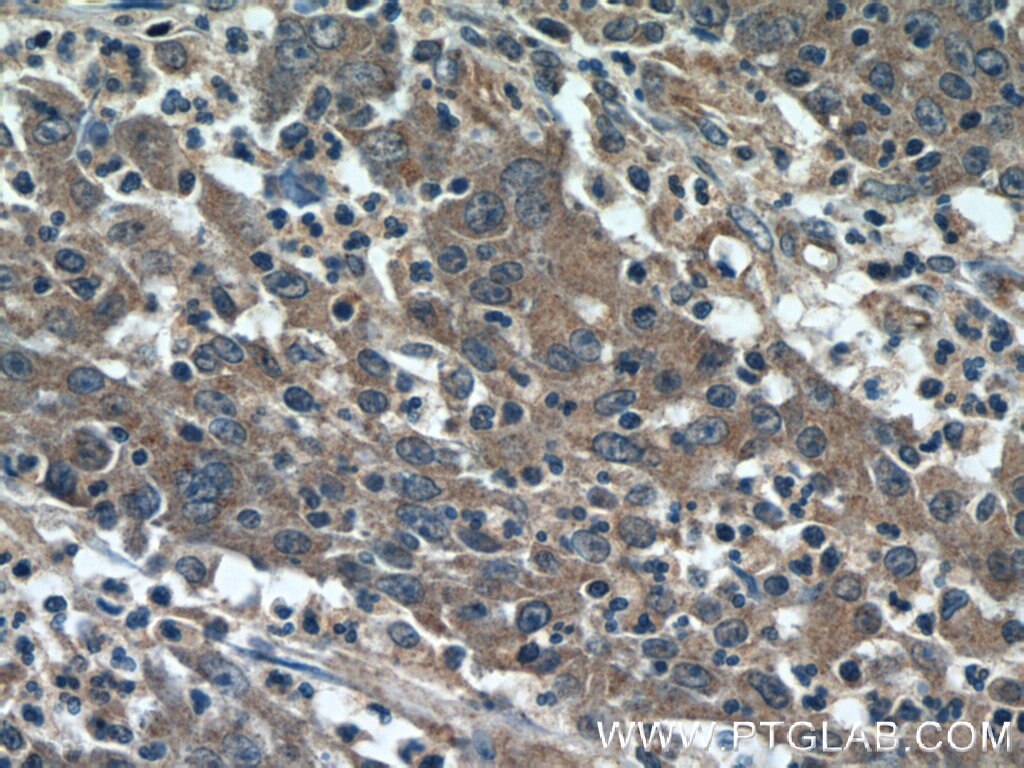 Immunohistochemistry (IHC) staining of human colon cancer tissue using PLA2G3 Polyclonal antibody (17646-1-AP)