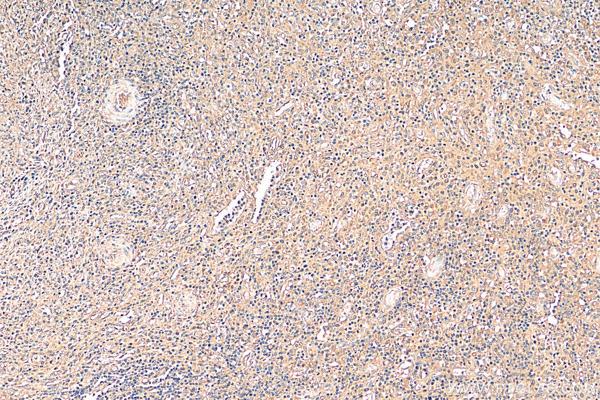 Immunohistochemistry (IHC) staining of human colon cancer tissue using PLA2G4A Polyclonal antibody (28924-1-AP)