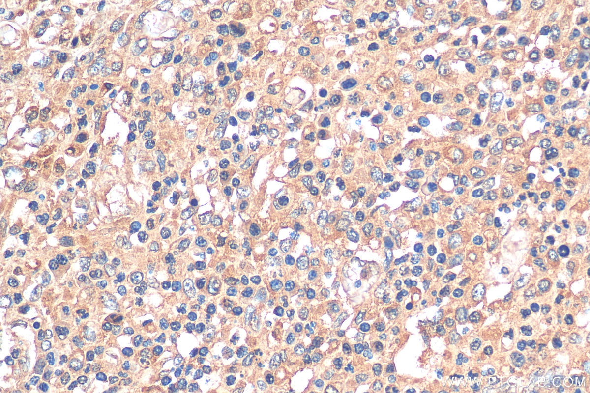 Immunohistochemistry (IHC) staining of human colon cancer tissue using PLA2G4A Polyclonal antibody (28924-1-AP)