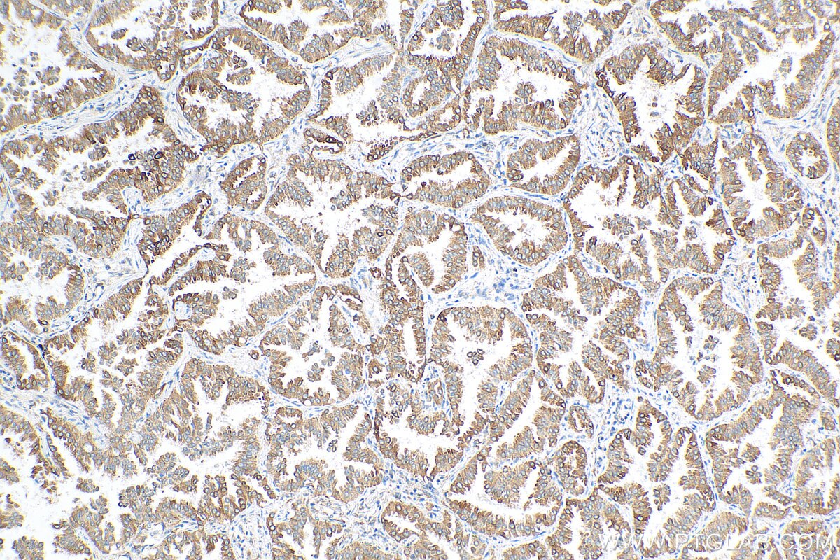 Immunohistochemistry (IHC) staining of human lung cancer tissue using PLA2G4A Monoclonal antibody (68133-1-Ig)